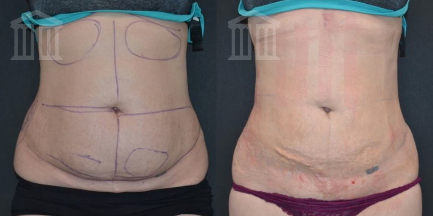 BodyTite result – abdomen, front view: before (left) and after (right) showing reduced volume and flatter contour