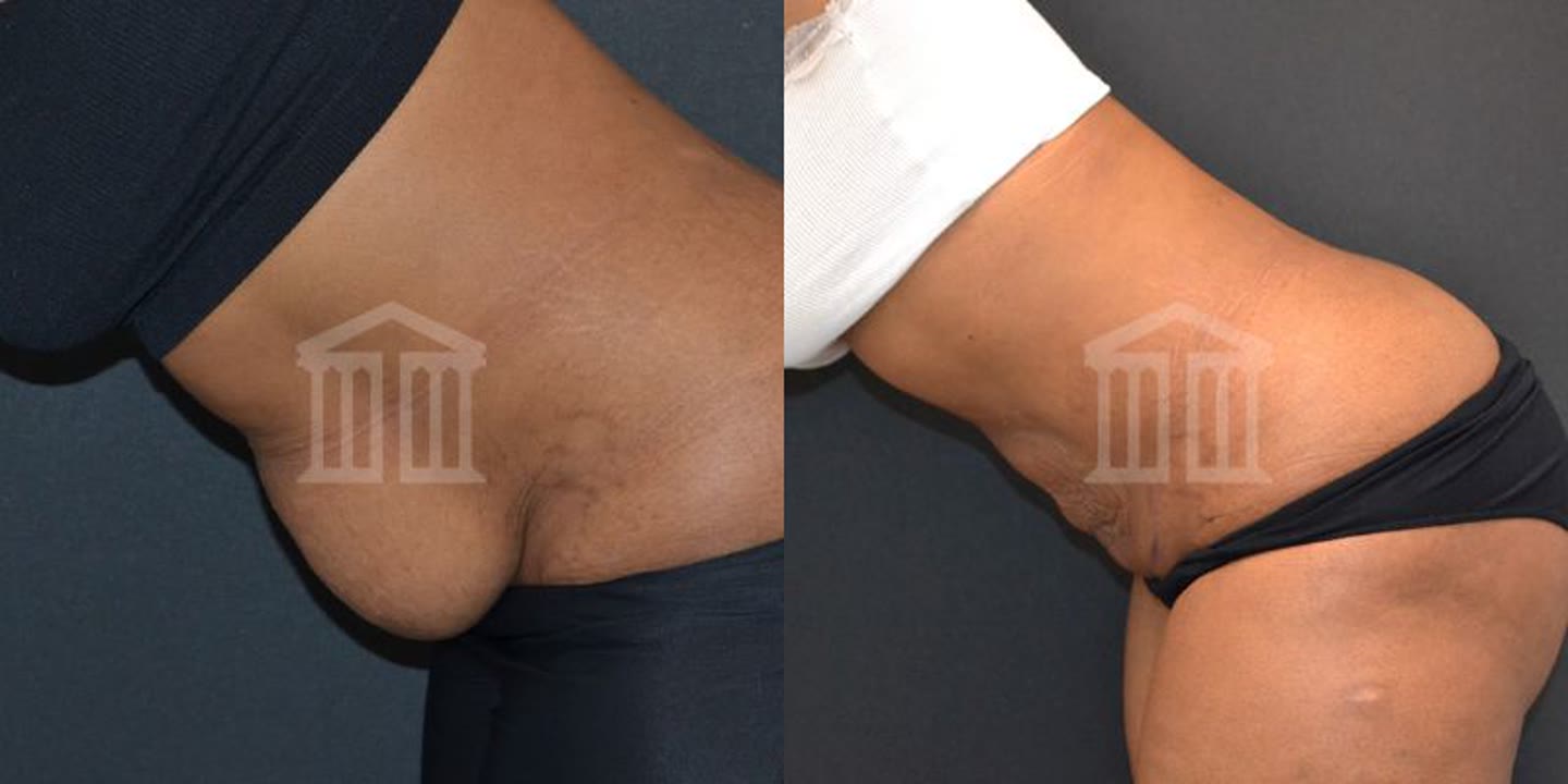 BodyTite result – abdomen, side view: before (left) and after (right) showing reduced volume and firmer contour