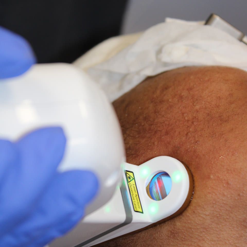 Gloved hand pressing a laser treatment device with green indicator lights against a patient's skin to treat age spots