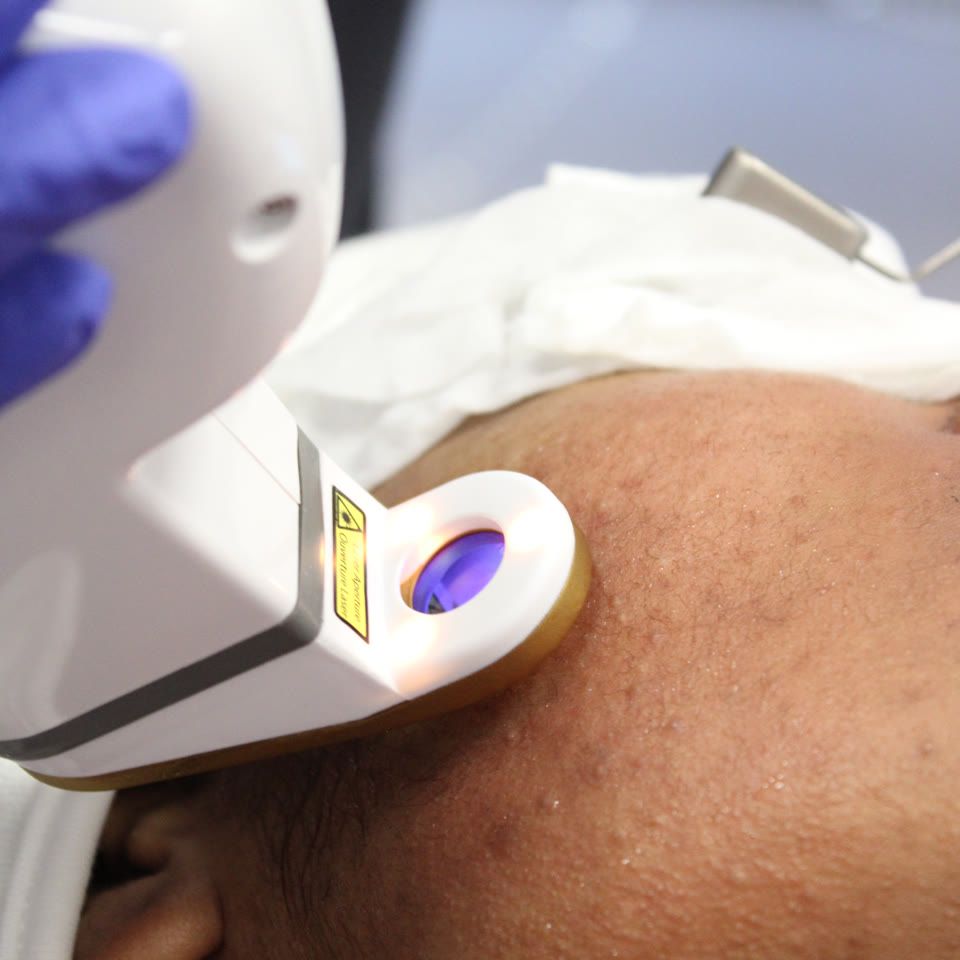 Laser treatment device held by gloved hand targeting a cafe au lait patch on a patient's shoulder