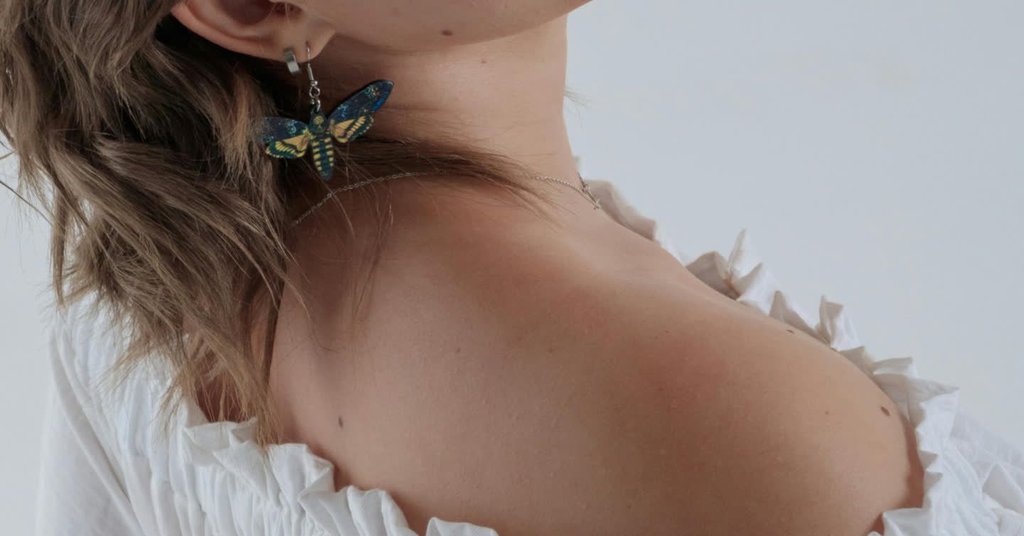 Close-up of a woman's neck and shoulder showing a port-wine stain birthmark, wearing a butterfly earring and white top