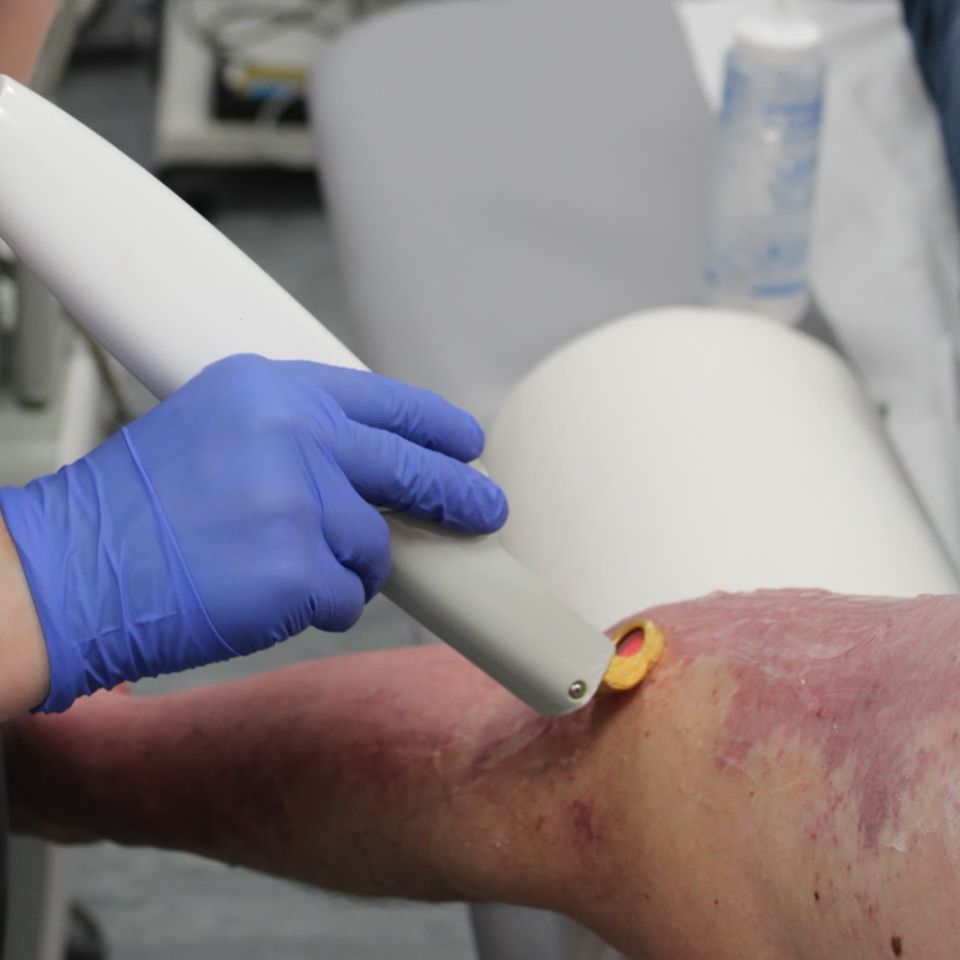 Gloved clinician applying a laser treatment device to a reddish birthmark on a patient's leg during birthmark removal