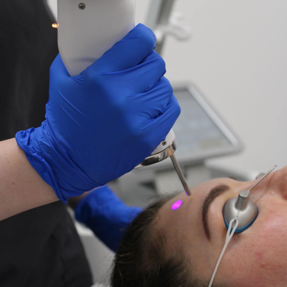 Practitioner wearing blue gloves applying AviClear acne treatment laser to a patient's forehead with protective eye shields