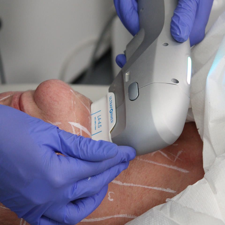 Practitioner applying Ultraformer HIFU device to a patient's marked neck area in a clinical treatment setting