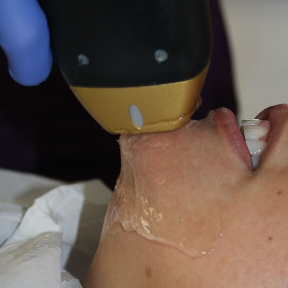 Practitioner applying a skin tightening laser device to a client's chin and jawline coated in cooling gel