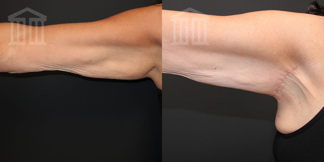 Before & After: Arm Lift