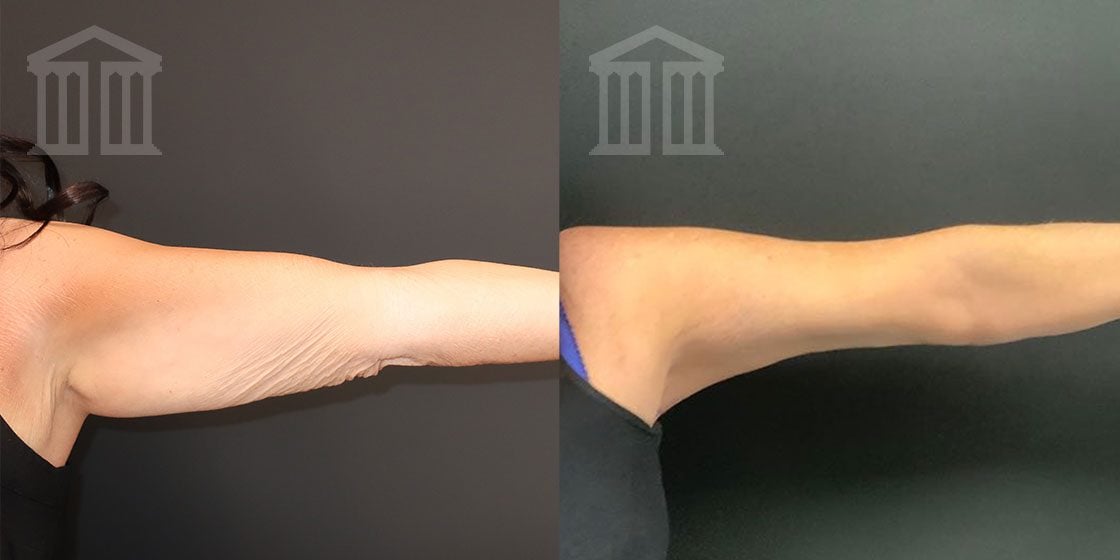 Before & After Arm Lift  Zenith Cosmetic Clinics