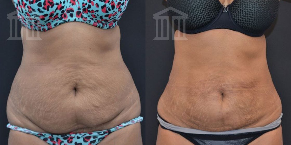 Bodytite Before And After Images