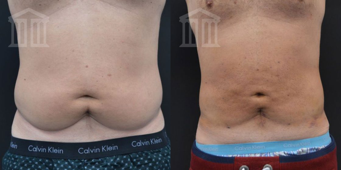 Bodytite Before And After men tummy