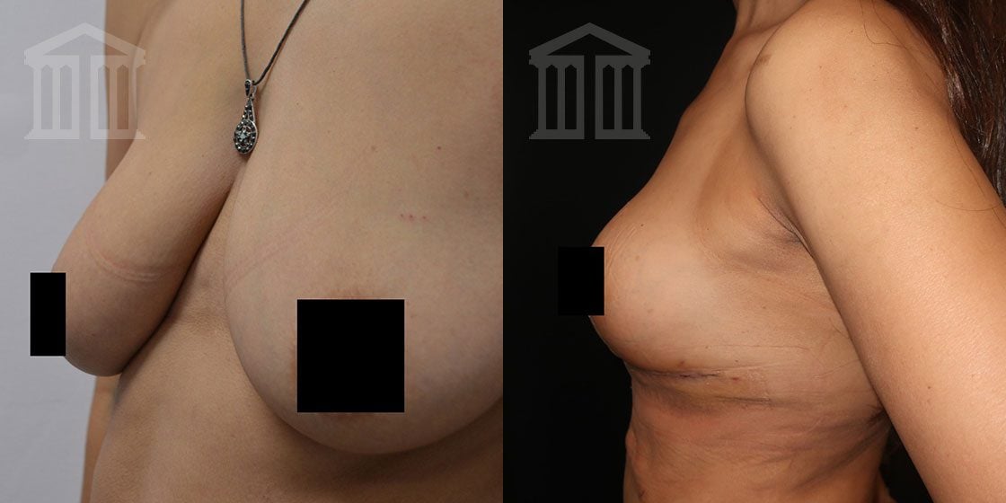 Uneven Nipples / Asymmetrical Breasts