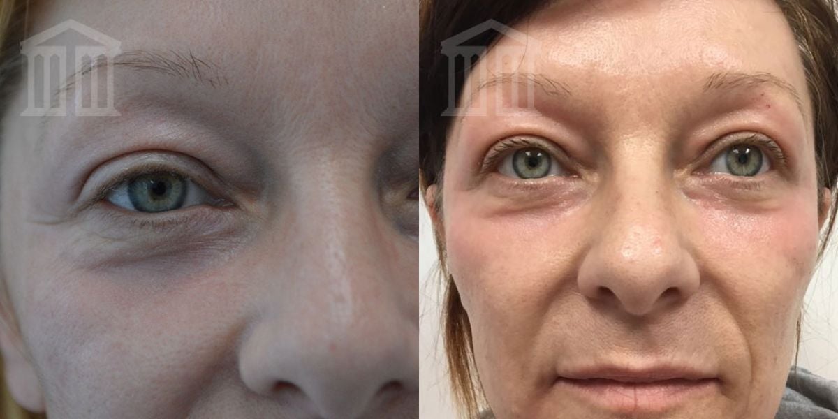 Before & After: Co2 Laser