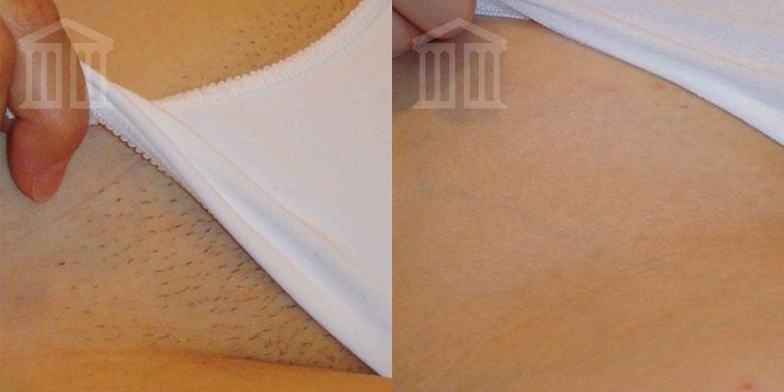 Before and After: Laser Hair Removal