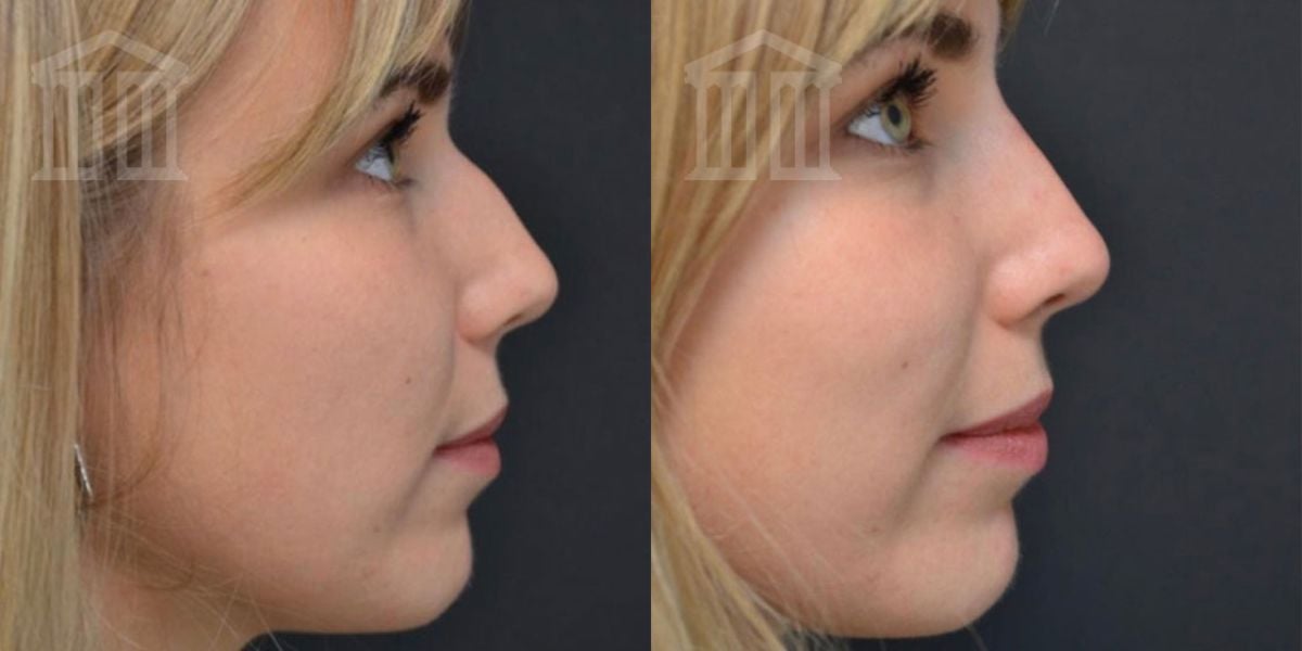 Before and After: Non Surgical Rhinoplasty