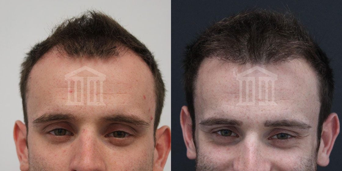 Before And After: PRP Hair Rejuvenation Therapy