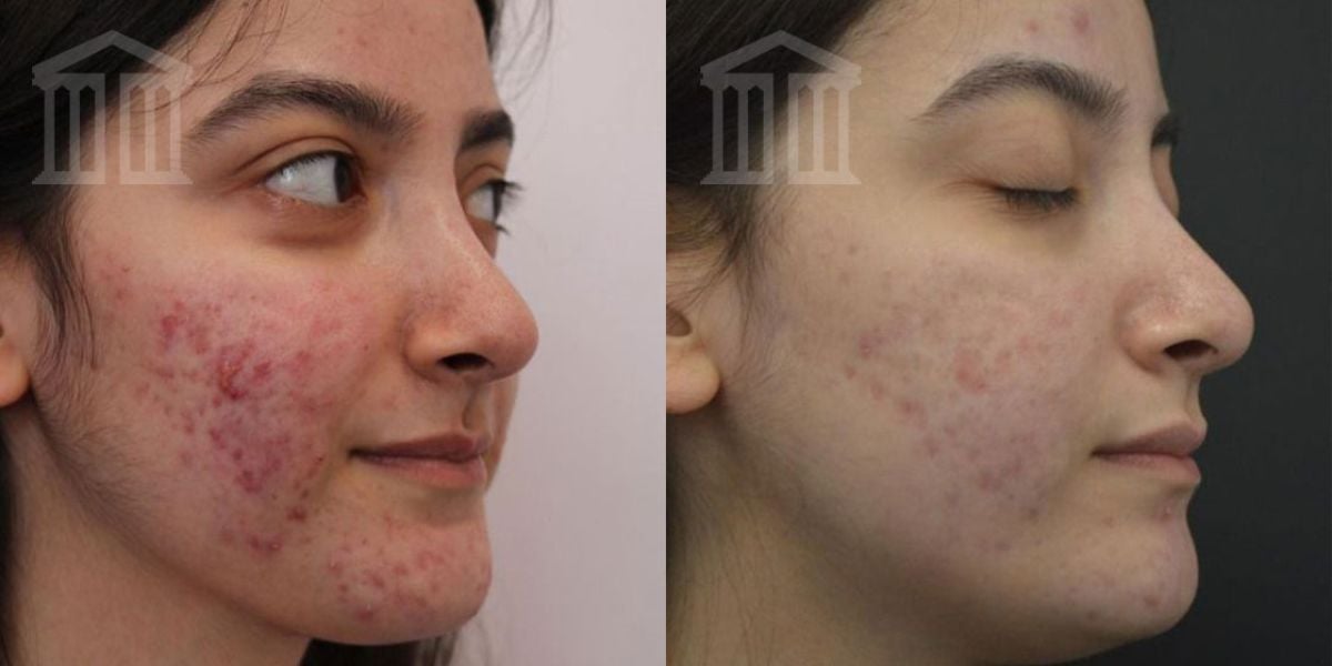 Before & After: Skin Peels