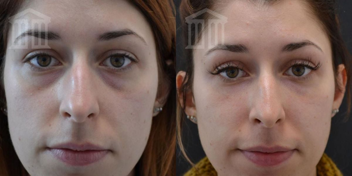 Before And After: Tear Trough Filler