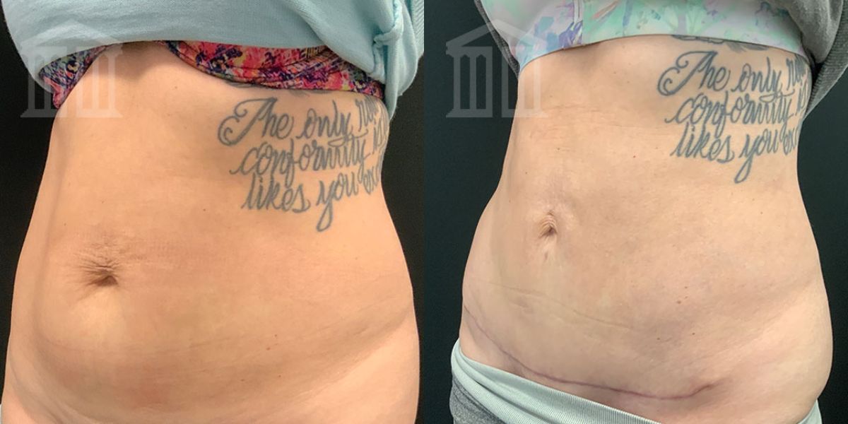 tummy tuck after having a tattooTikTok Search