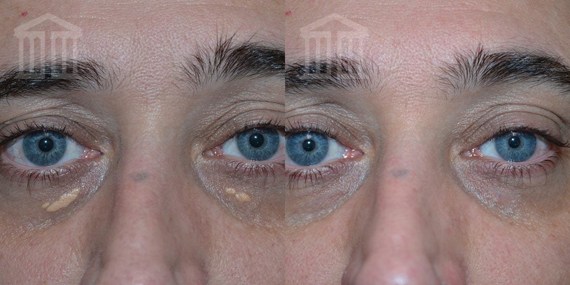 Before And After: Xanthelasma