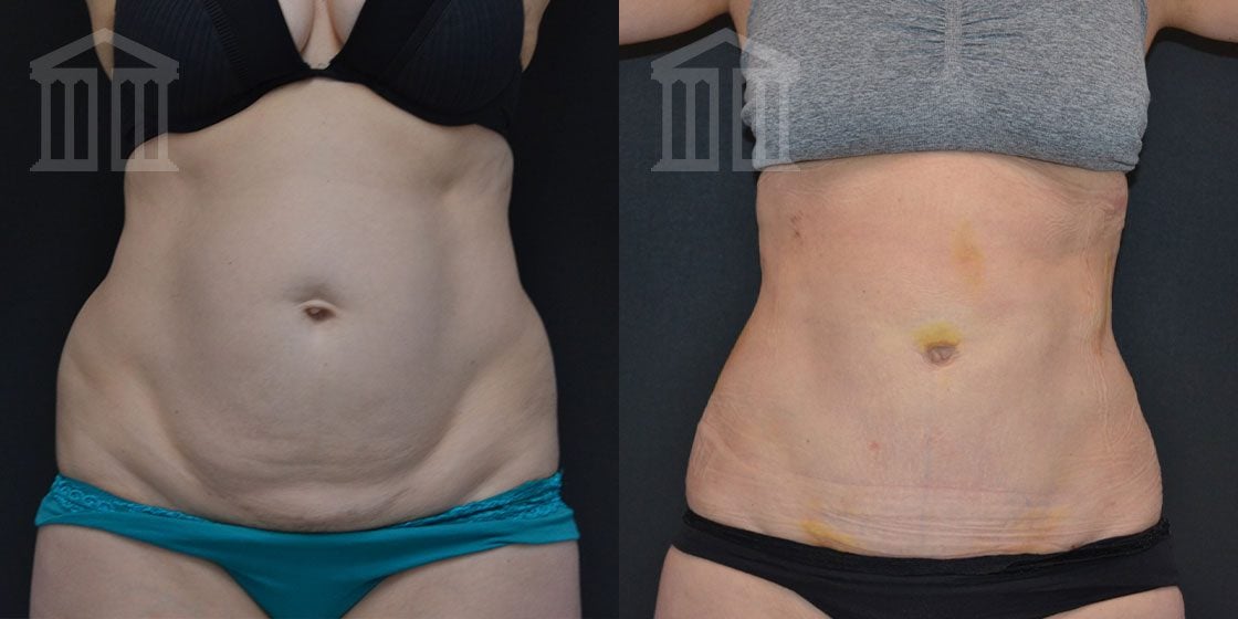 Bodytite Before And After Images |