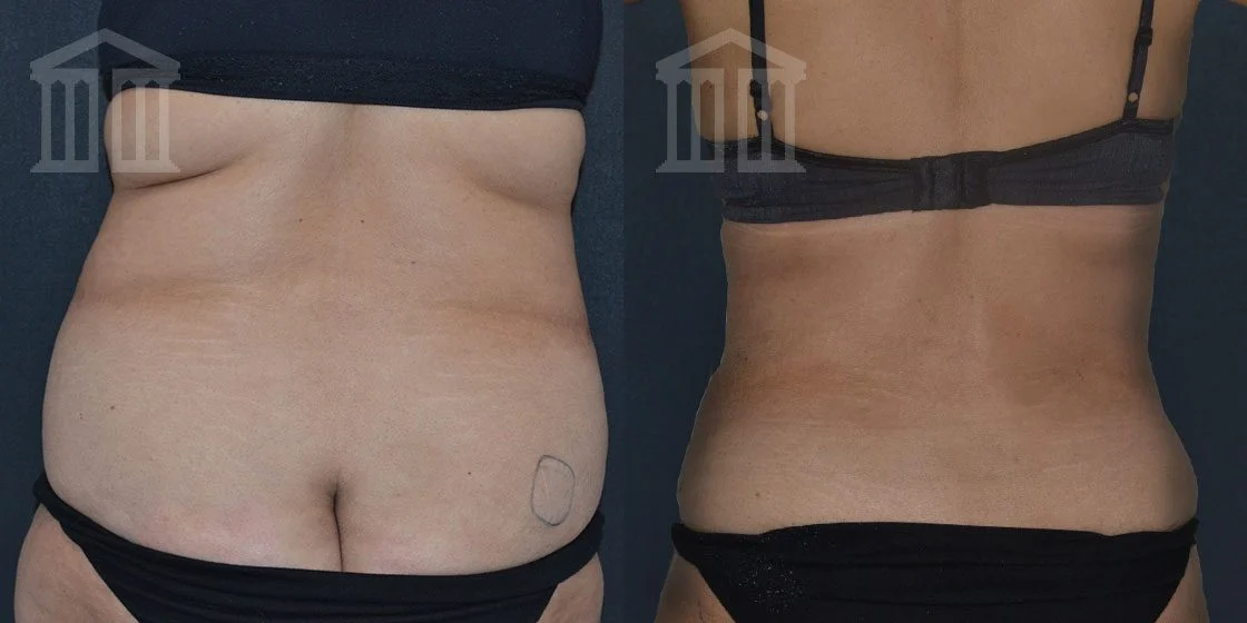 Bodytite Before And After hips