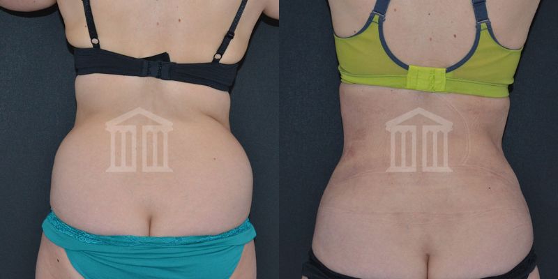 Bodytite Before And After Images