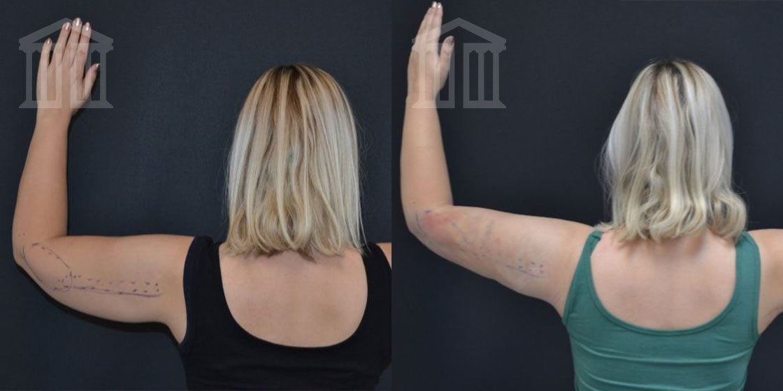 Bodytite Before And After arms