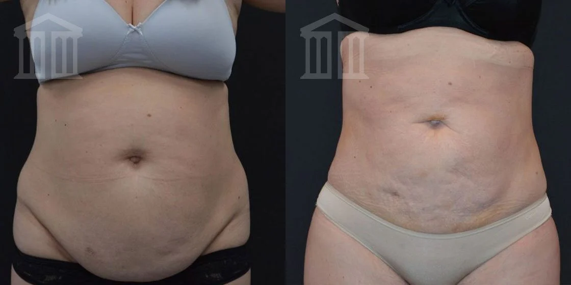 Bodytite Before And After belly