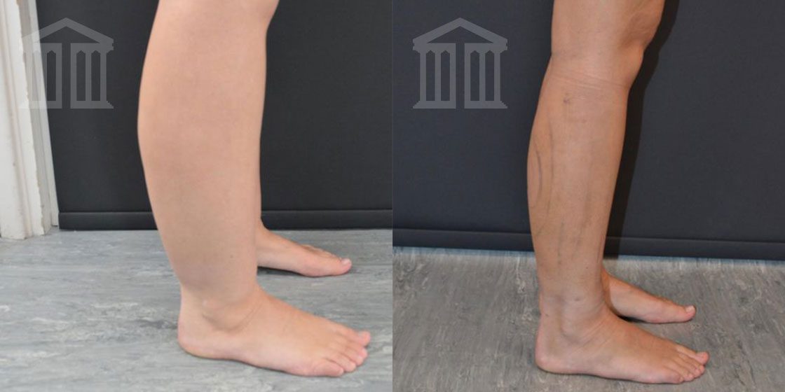 Bodytite Before And After legs