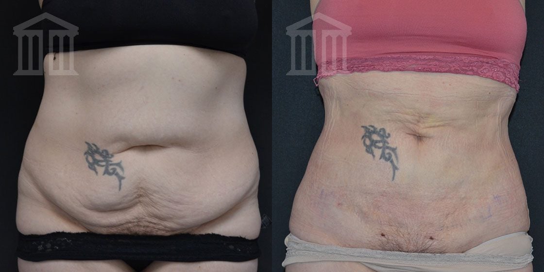 Bodytite Before And After Images