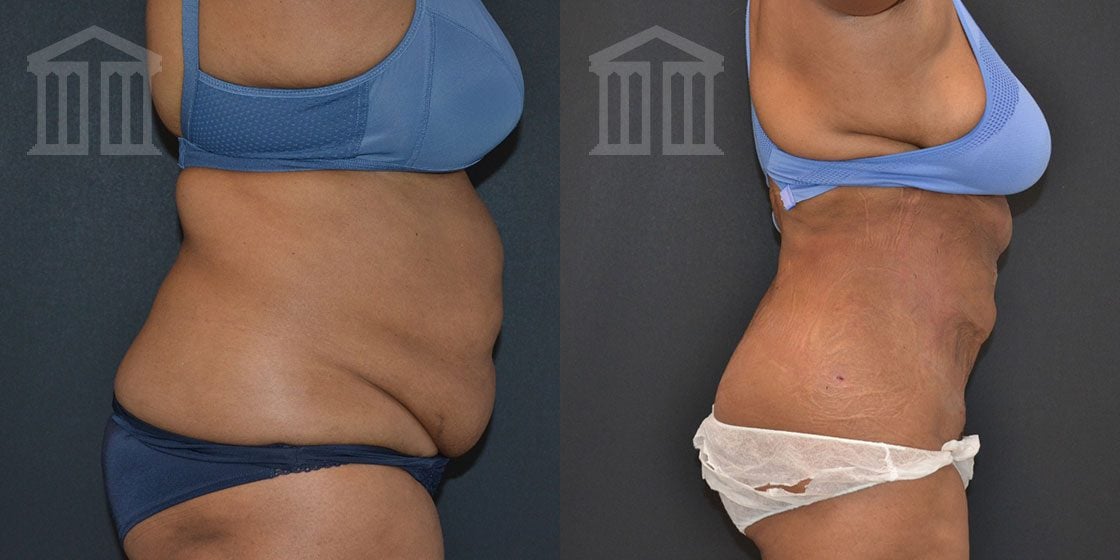 Tummy tuck skin tightening co2 laser therapy - Eve Clinics