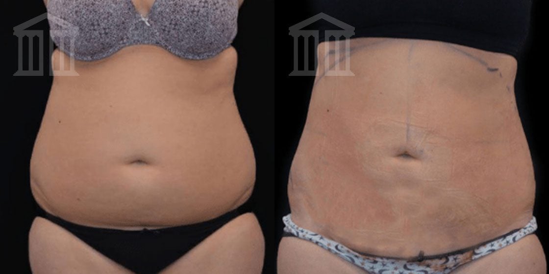 Bodytite Before And After stomach