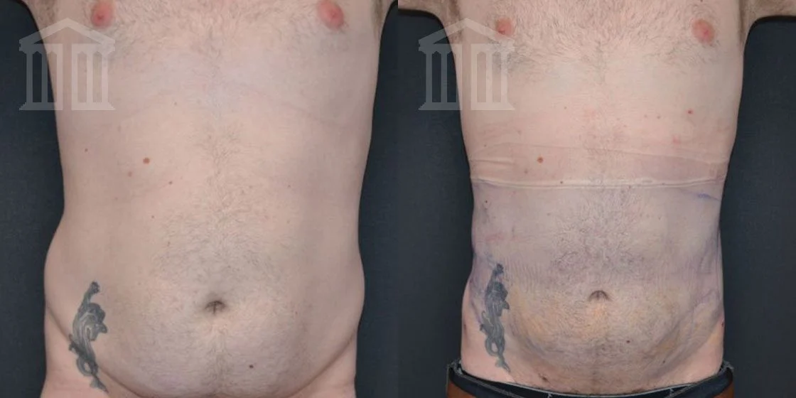 Before and After - Belly Button Lifting - UK Cosmetic Clinic