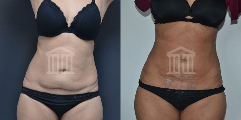 Advanced Abdominoplasty Procedure and tummy tuck in the UK