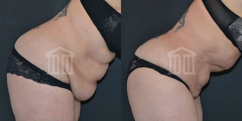 Tummy Tuck Before and After Pictures Case 69