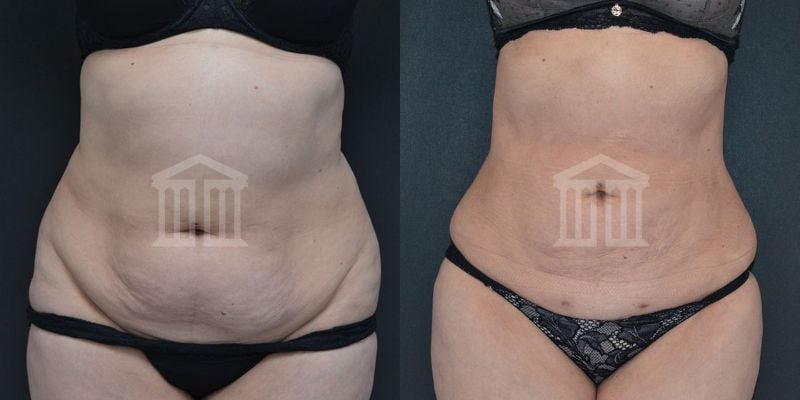 Bodytite Before And After Images