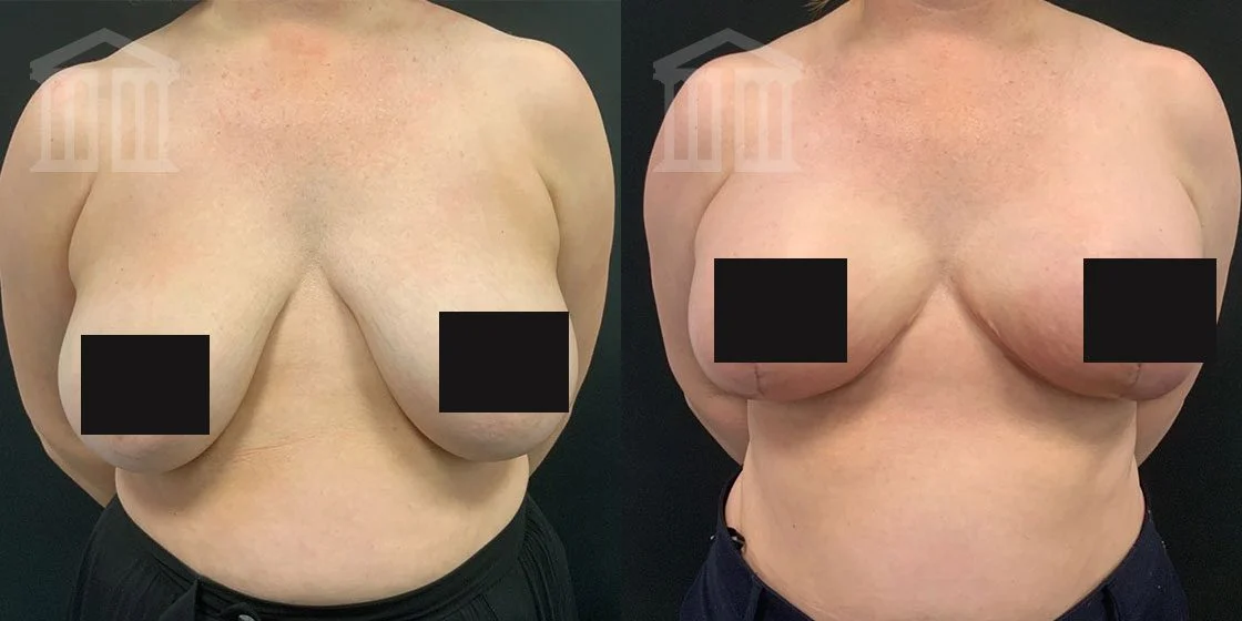 Before & After: Breast uplift (Mastopexy)