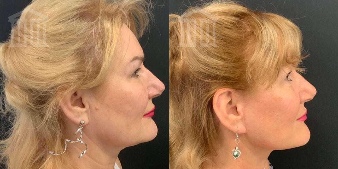 Before and After: Facelift