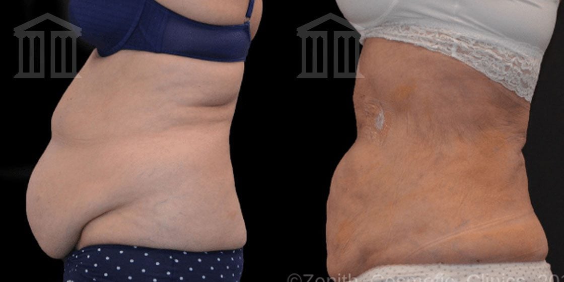 Bodytite Before And After Images