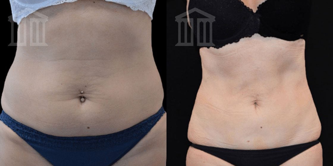 Bodytite Before And After Images