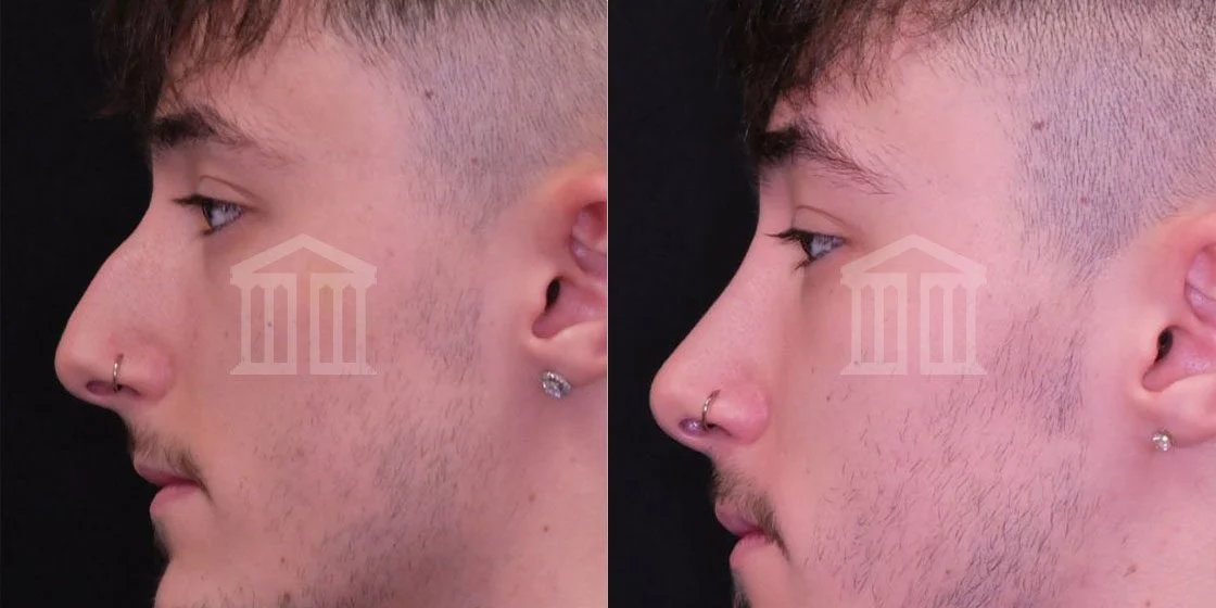 Before & After: Male Rhinoplasty