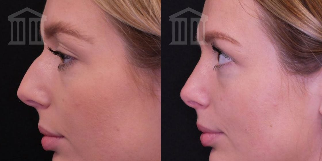 Before and After: Rhinoplasty