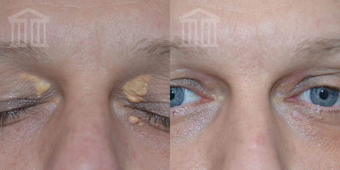 Xanthelasma Removal Zenith Cosmetic Clinics 