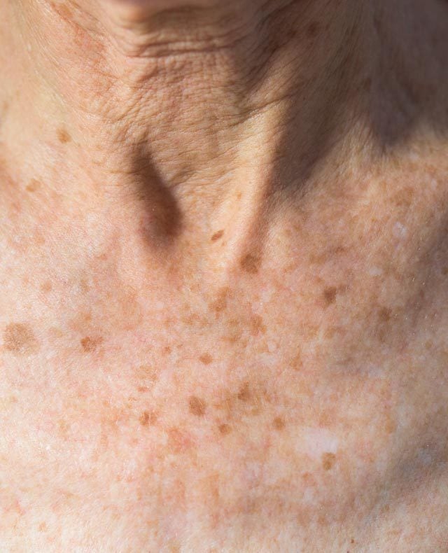 Age Spots/Brown Spots, Elite Medical & Aesthetics