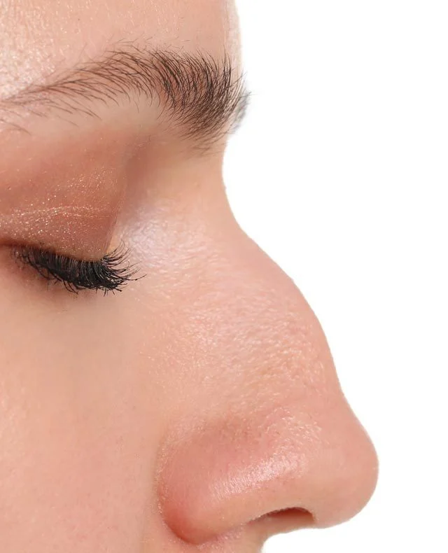 Bump On Nose | Zenith Cosmetic Clinics