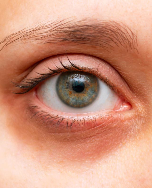 What causes dark circles deals around eyes nhs