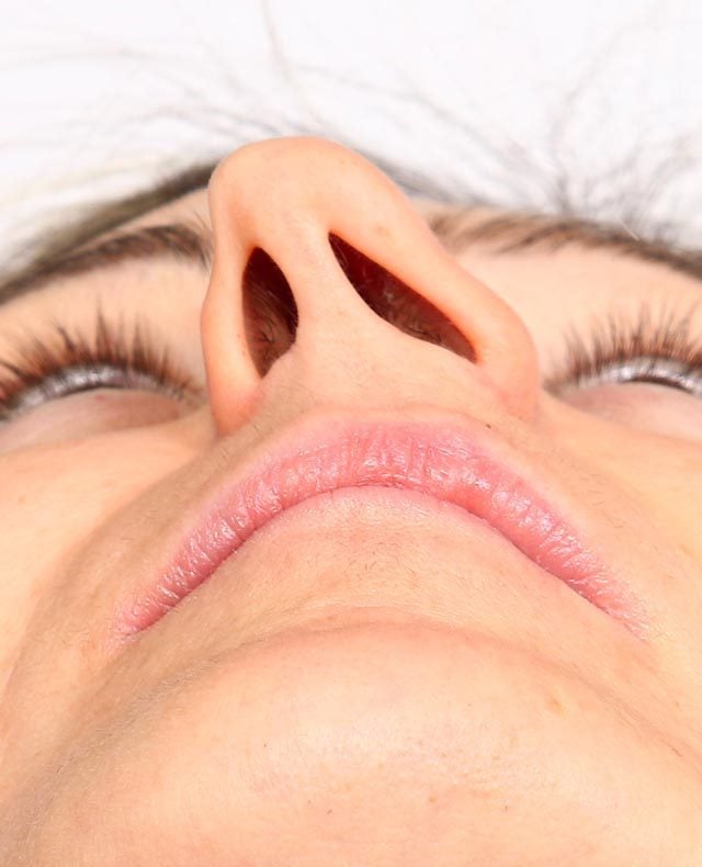 deviated septum nostrils