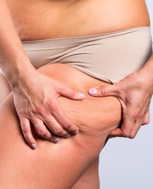 Do you have excess outer thigh fat?