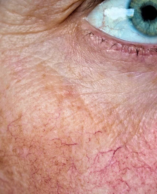 Facial Thread Veins