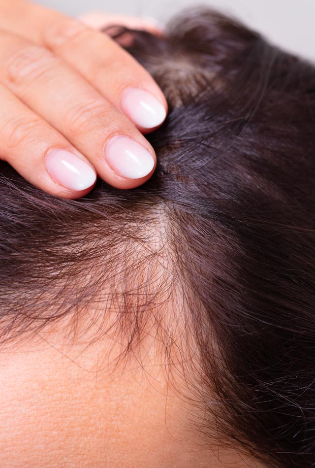 Hair Loss | Zenith Cosmetic Clinics Hair Loss | Zenith Cosmetic Clinics