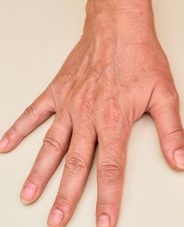 Hand Rejuvenation